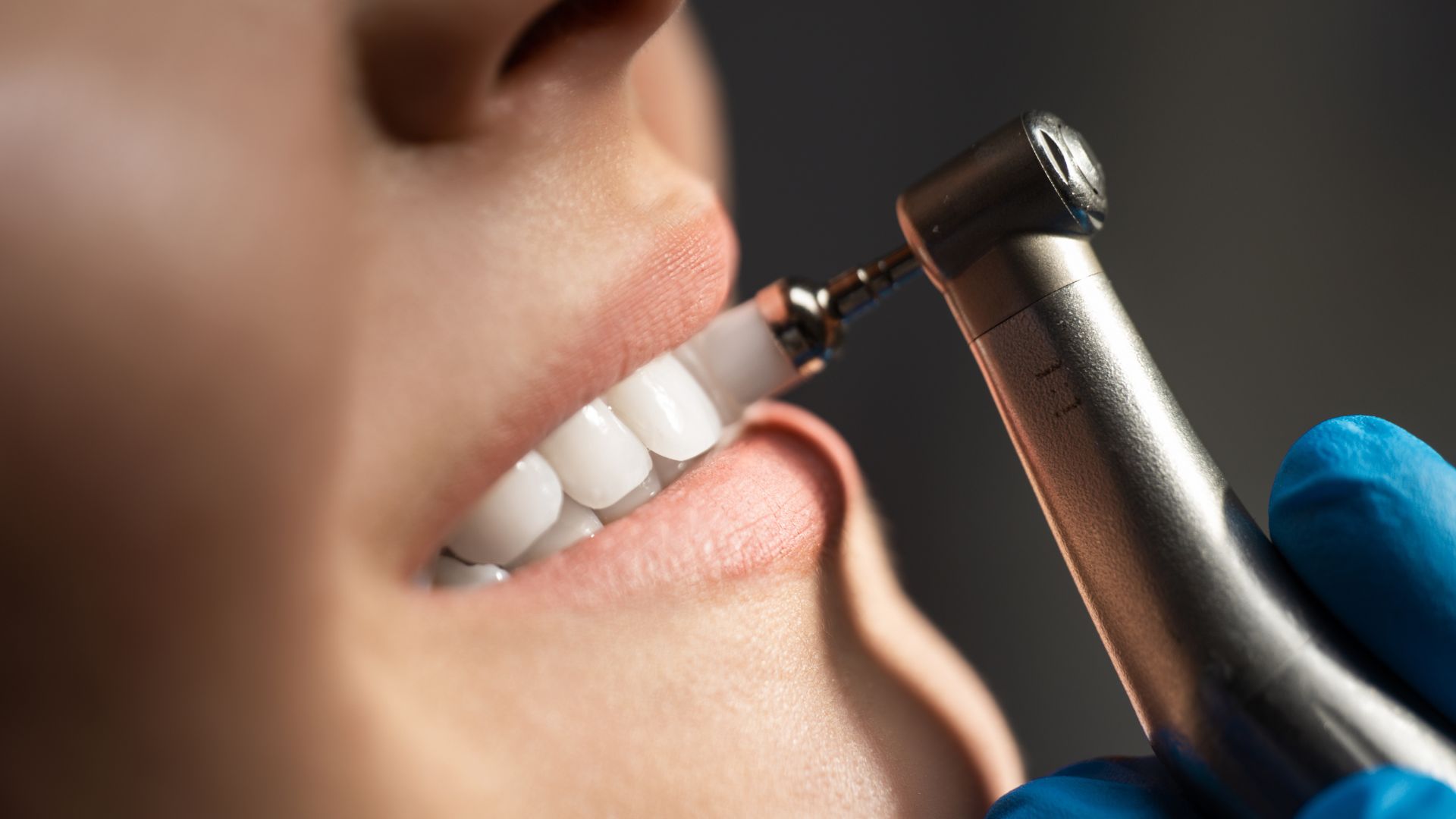 ESTÉTICA DENTAL (BLANQUEAMIENTO, CARILLAS…)